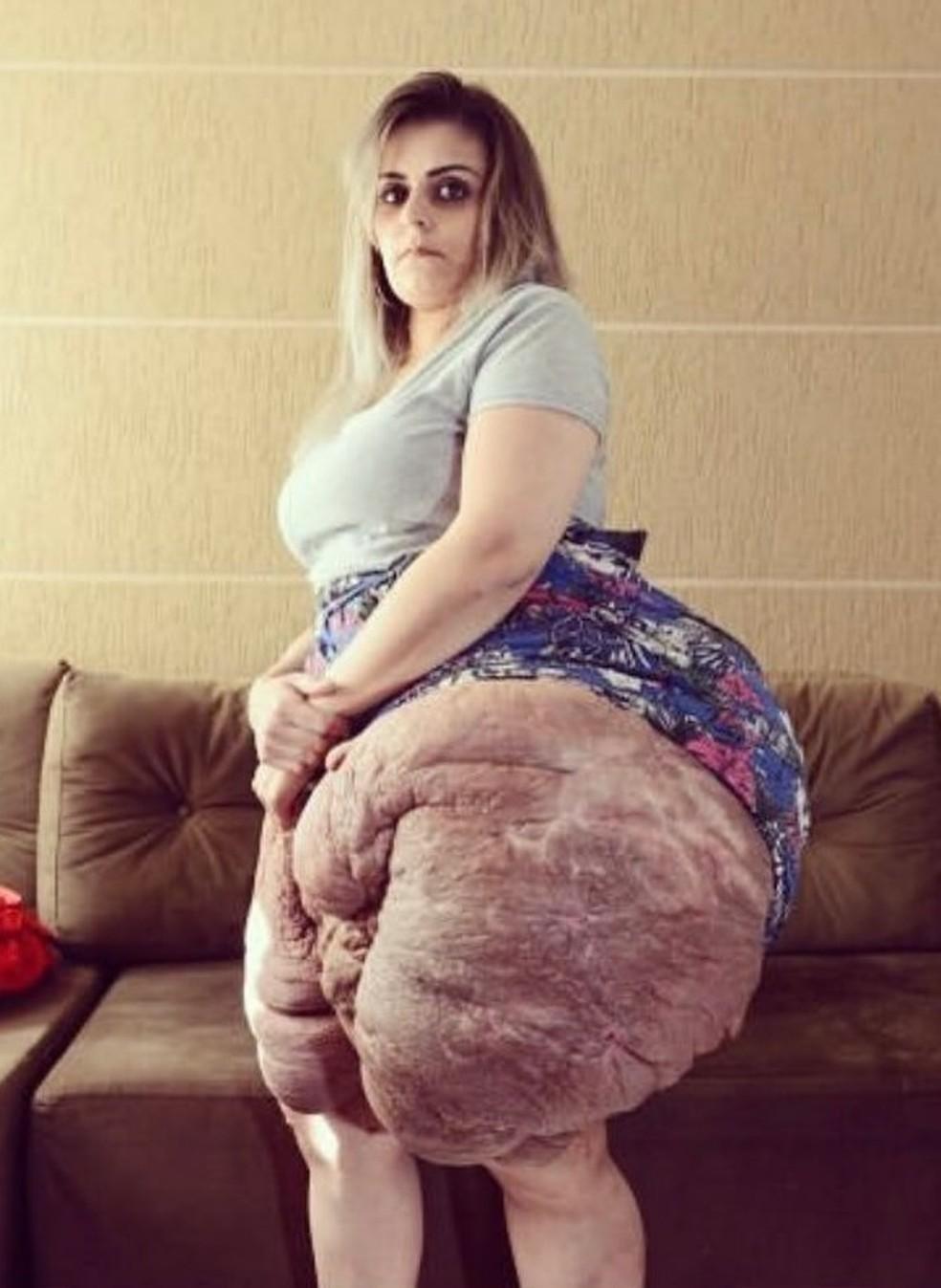 Karina retirou tumor de 30 kg da regio das pernas Foto Arquivo pessoal