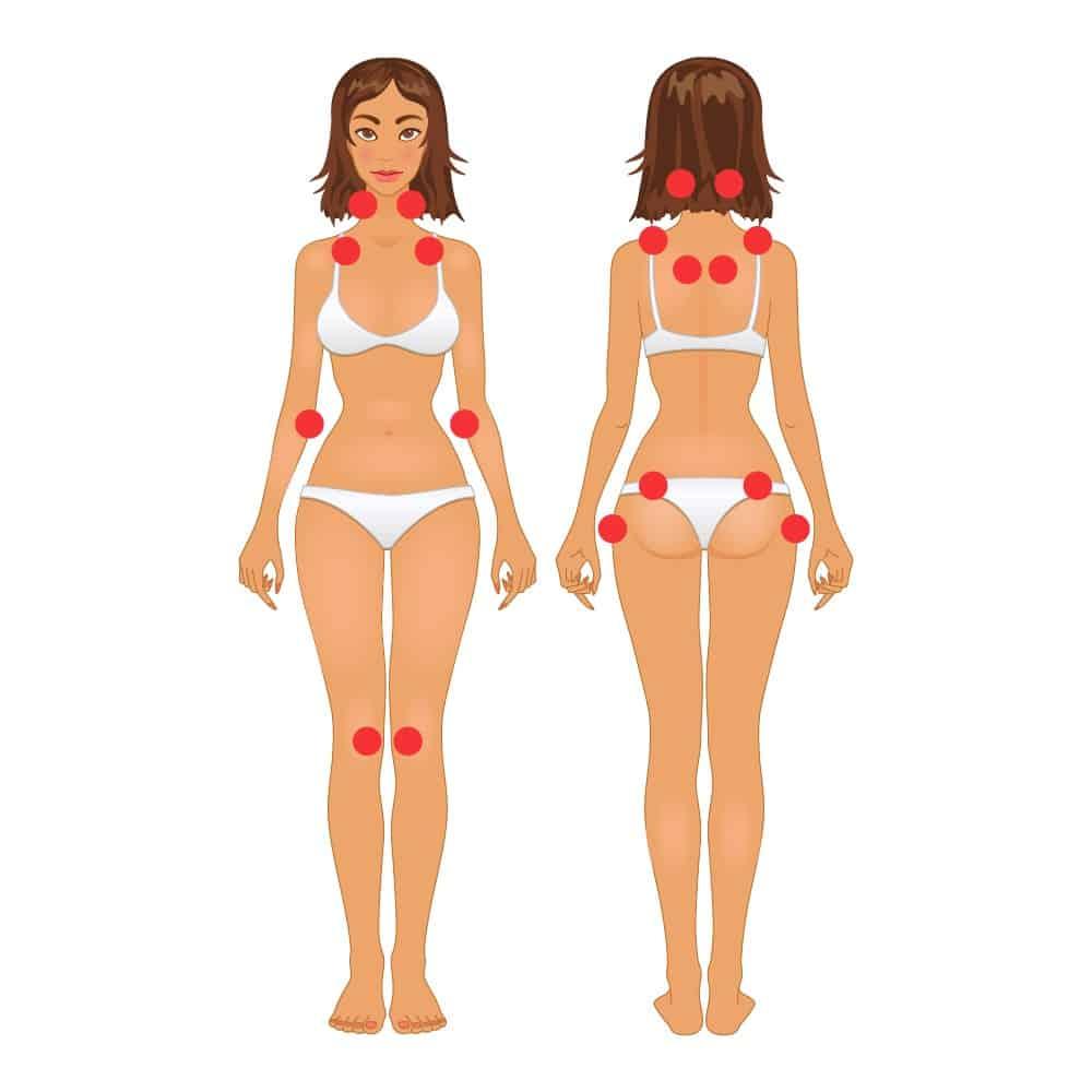 Pontos de dor mais frequentes na fibromialgia