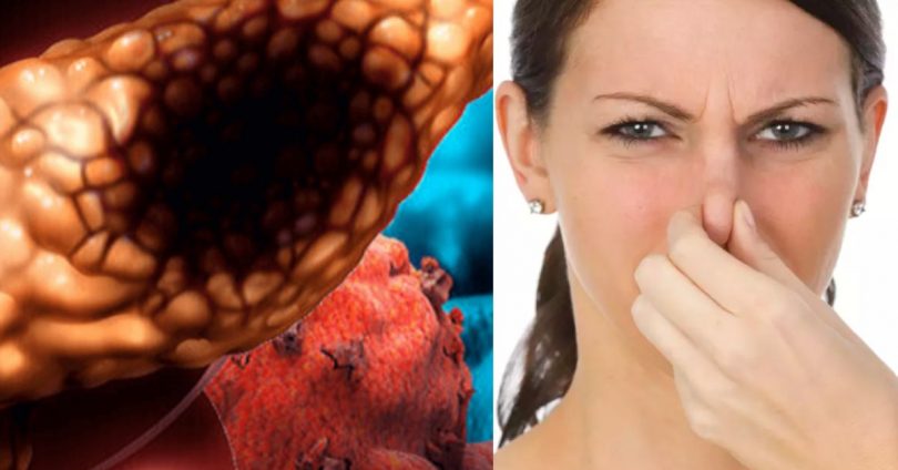 Câncer de pâncreas O cheiro das fezes por ser um dos sintomas deste câncer silencioso e letal