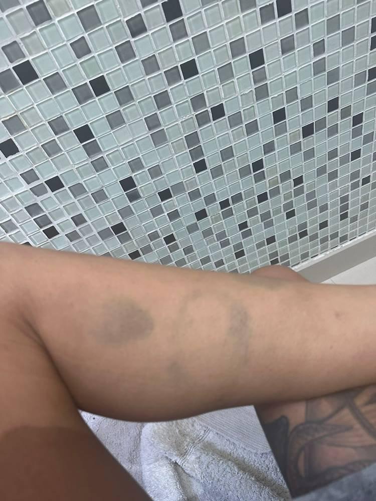 Hematomas de Tati Zaqui em foto apresentada por ela para a polcia ao denunciar Thomaz Costa por agresso