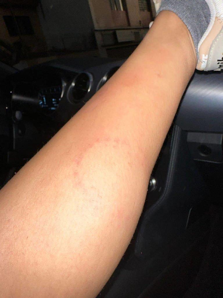 Hematomas de Tati Zaqui em foto apresentada por ela para a polcia ao denunciar Thomaz Costa por agresso