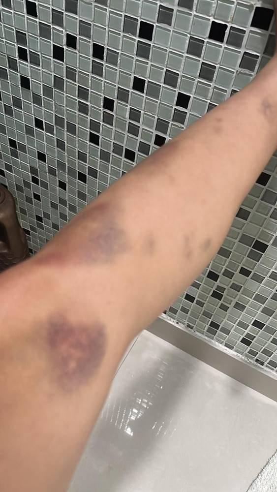 Hematomas de Tati Zaqui em foto apresentada por ela para a polcia ao denunciar Thomaz Costa por agresso