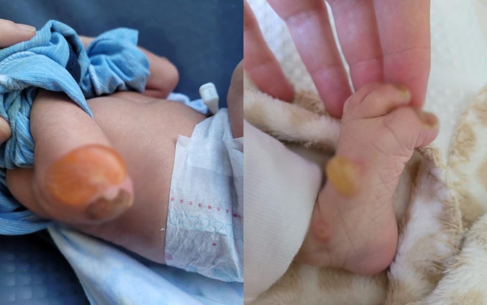 Morre beb diagnosticado com doena rara que torna pele to frgil quanto asas de borboleta em MG Foto Arquivo Pessoal