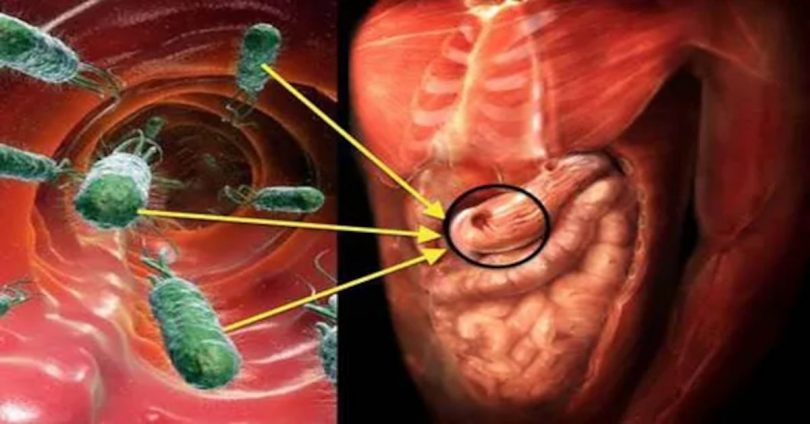 Bactéria Helicobacter pylori: Receitas caseiras para destruir essa ...