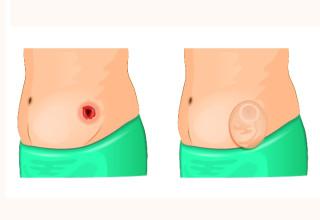 Ilustrao mostra estoma abertura feita na parede abdominal na imagem esquerda e na imagem direita colocao de bolsa de colostomia - Imagem Shutterstock