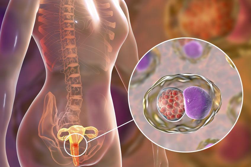 Tratamento cirrgico do cncer de colo do tero - Oncologista em So Paulo Dr Rafael Onuki Sato
