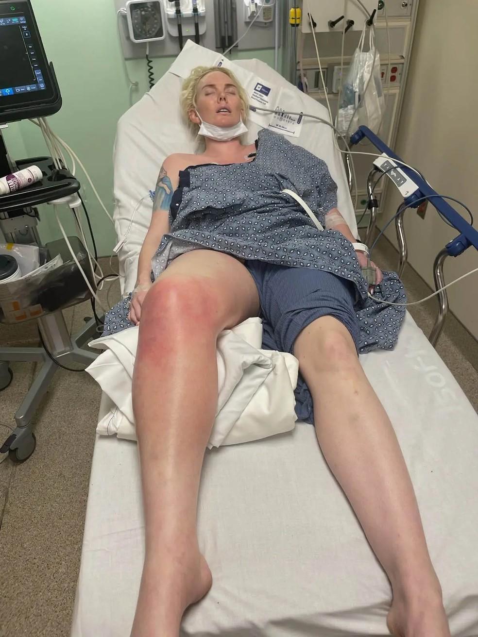 Jennifer Barlow teve fascite necrosante aps contrair a bactria em uma viagem para as Bahamas Foto Reproduo