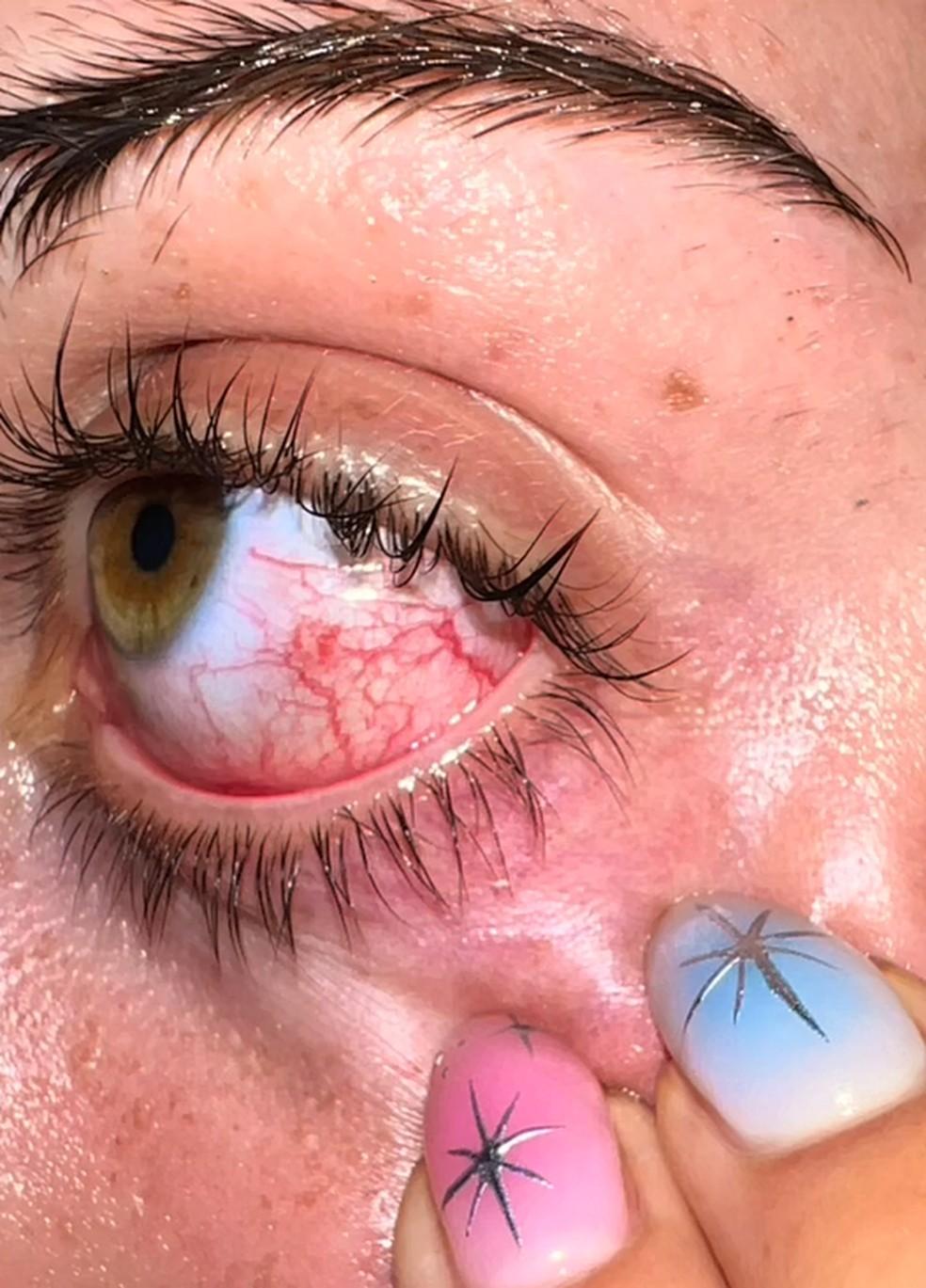 Sarah Jade mostra seu olho aps o ataque do pssaro Foto ReproduoTikTok