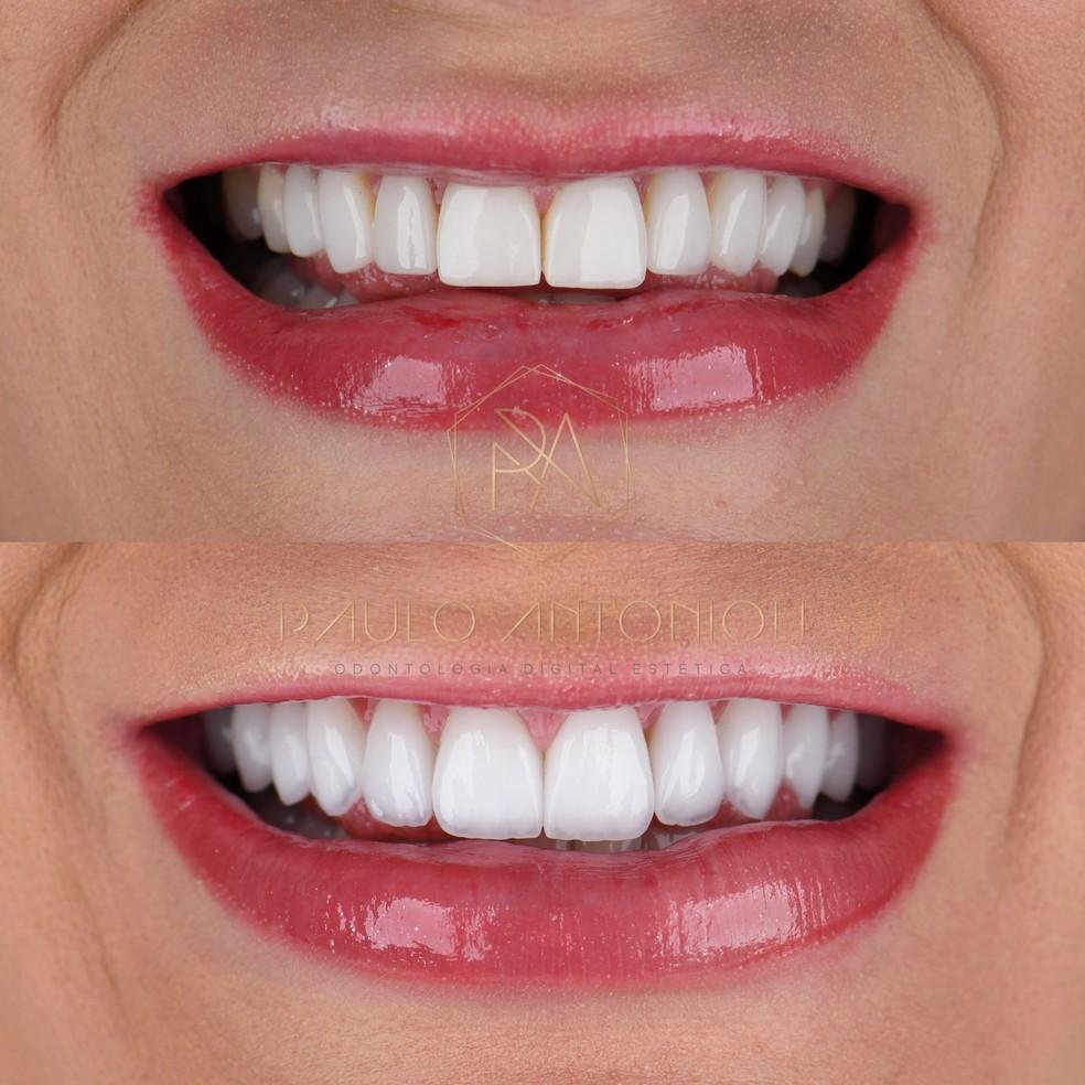 Image: https://mulherinteressante.com/wp-content/uploads/2024/01/postiimg-65ba82f8758188985.jpeg Antes e depois de arcada de Andressa Urach Foto Divulgao