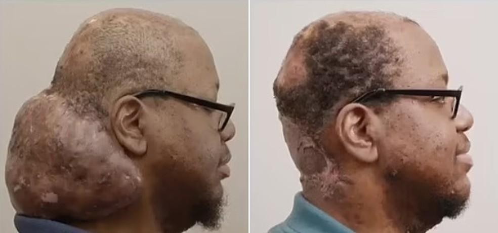 Homem se livra de tumor na nuca que cresceu por mais de dez anos Vivi como um monstro Foto Reproduo