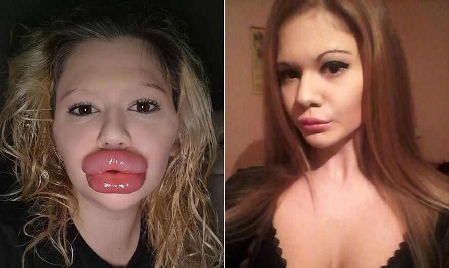 Andrea Ivanova blgara e afirma j ter investido cerca de R 100000 em preenchimento labial