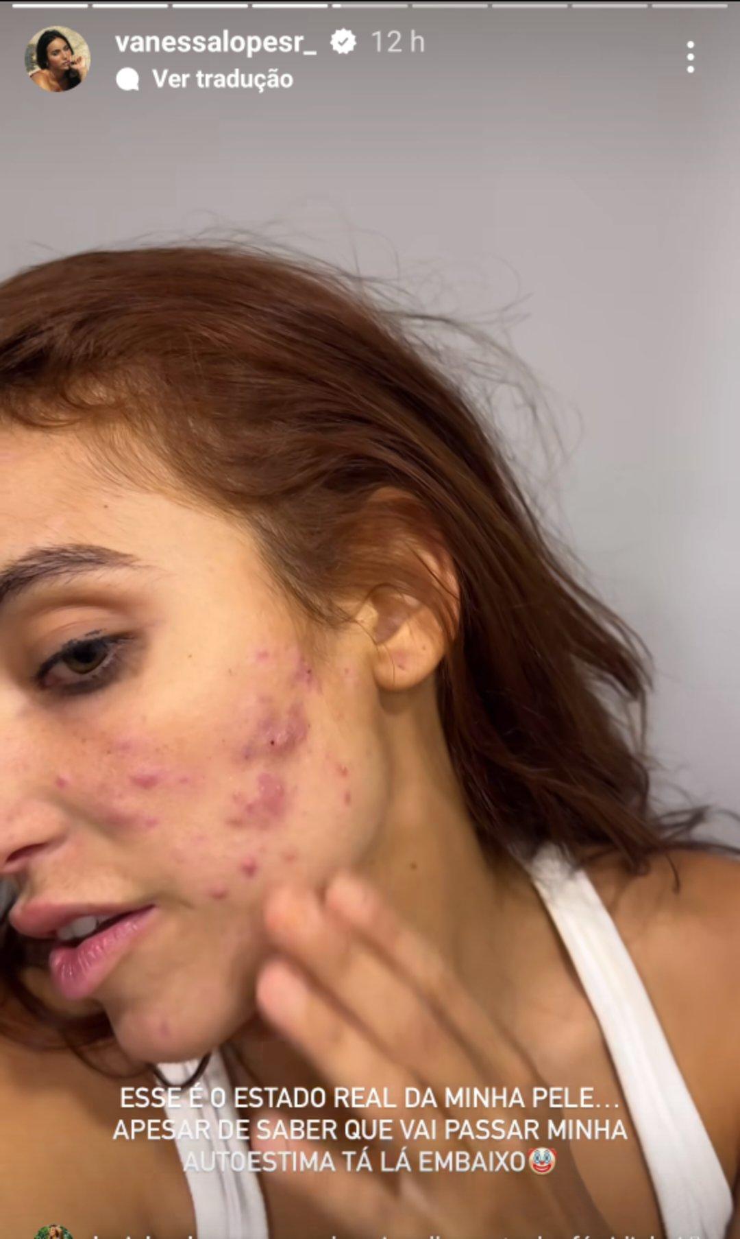 Image: https://mulherinteressante.com/wp-content/uploads/2024/09/postiimg-66e9b90d2885f9057.jpg Ex-bbb Vanessa Lopes mostra acne