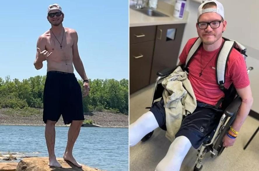 Dylan Riley antes e depois de ser infectado com bactria e precisar amputar as duas pernas
