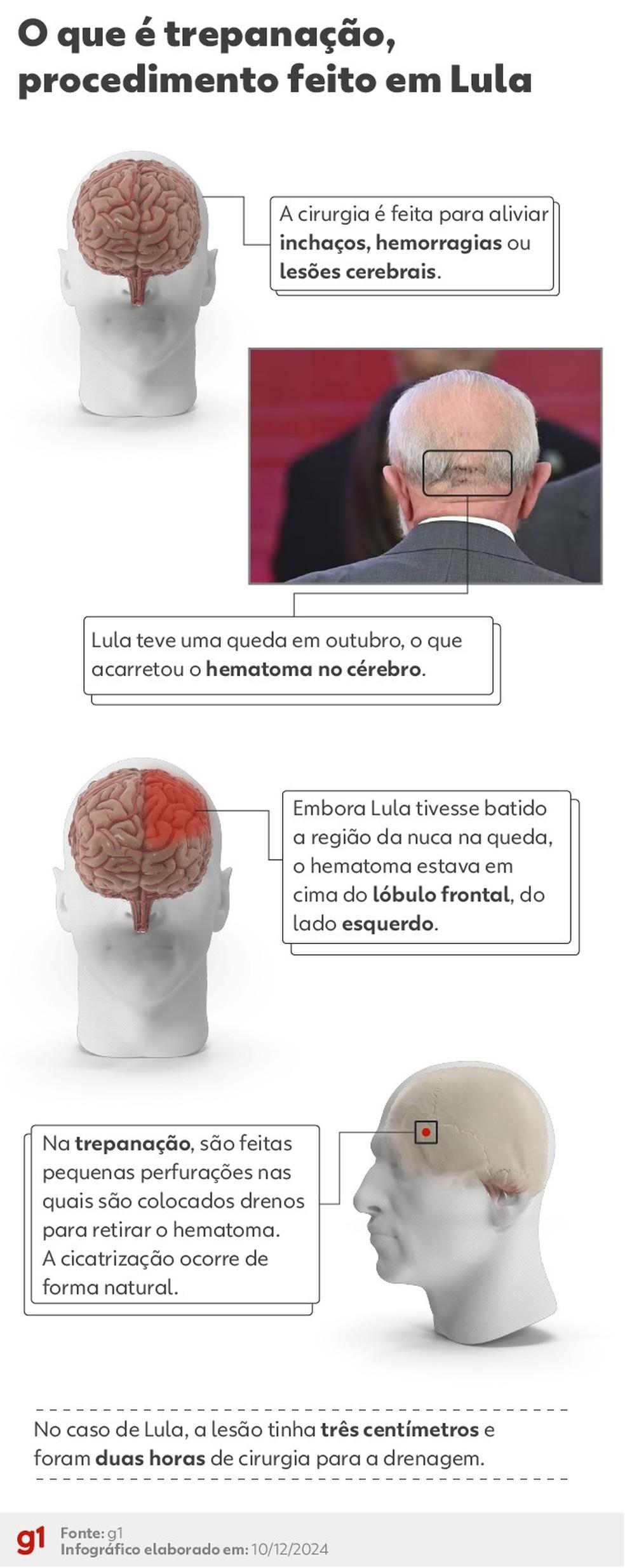 Trepanao entenda procedimento feito em Lula Foto Arteg1