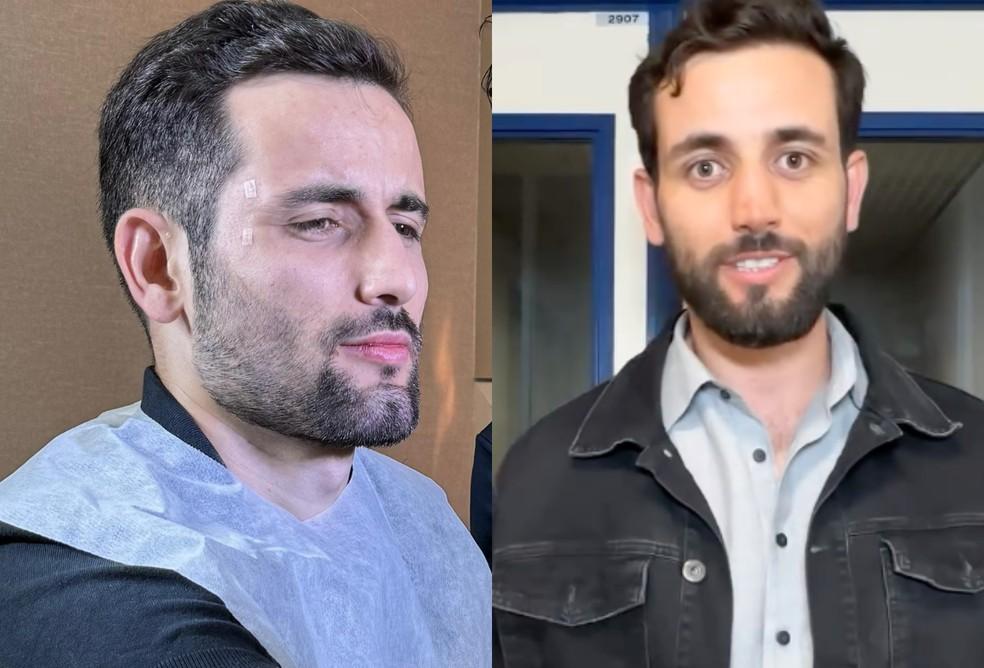 Ex-BBB Matteus passa por harmonizao facial veja como ficou