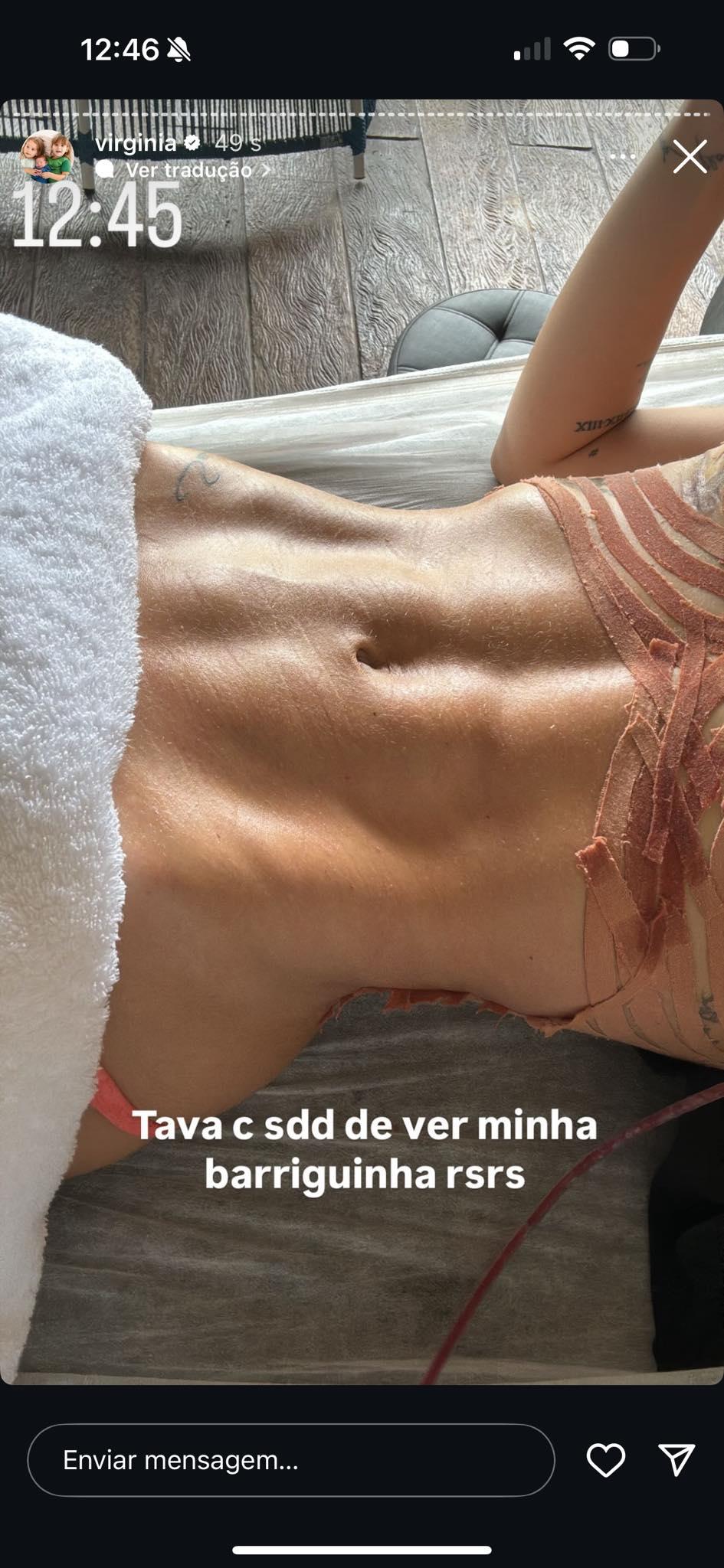 Virginia mostra o resultado da cirurgia de hrnia umbilical