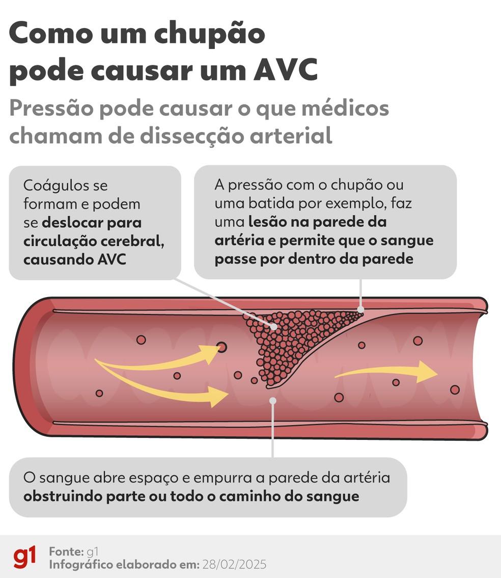 Arte explica como chupo acabou levando a um AVC Foto Arteg1