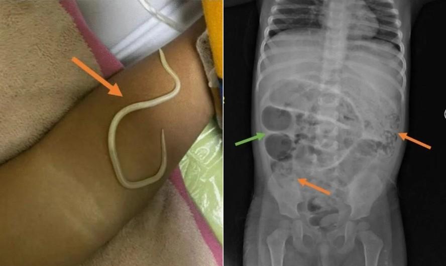 Os mdicos descobriram que as dores e inchaos eram causados por dezenas de vermes em seu trato digestivo