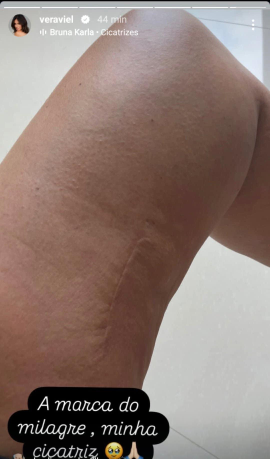 Vera Viel mostra cicatriz
