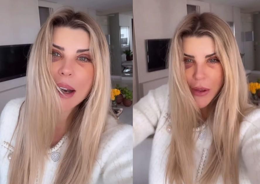 Ex-BBB ris Stefanelli faz cirurgia no rosto e aparece com os olhos roxos