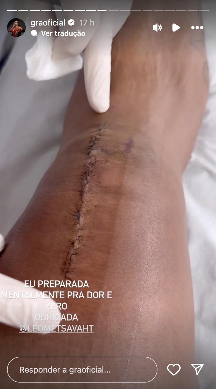 Gracyanne Barbosa mostra a cicatriz no joelho - Foto Reproduo Instagram