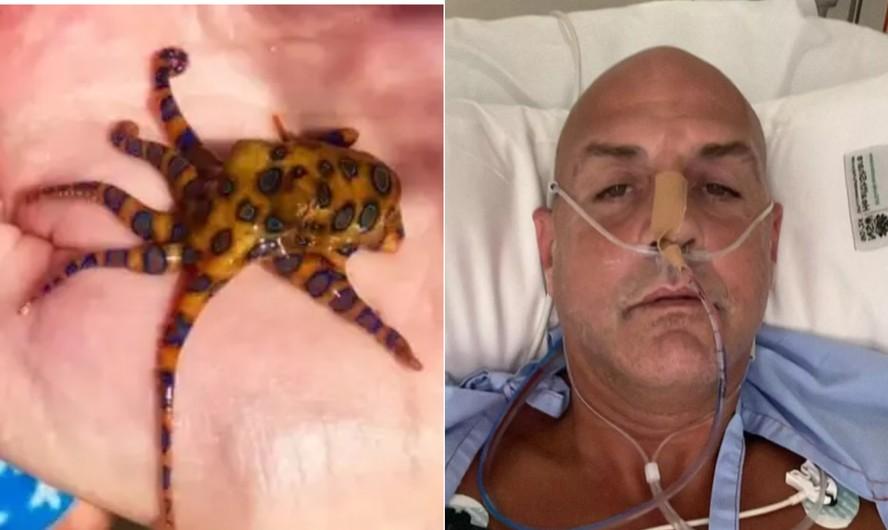 Juan-Paul Kalman teve que ficar 20 horas em coma induzido por conta de veneno do polvo-de-anis-azuis