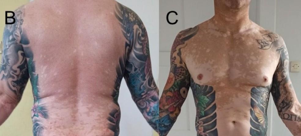 Homem desenvolveu vitiligo aps tatuagem Foto Divulgao