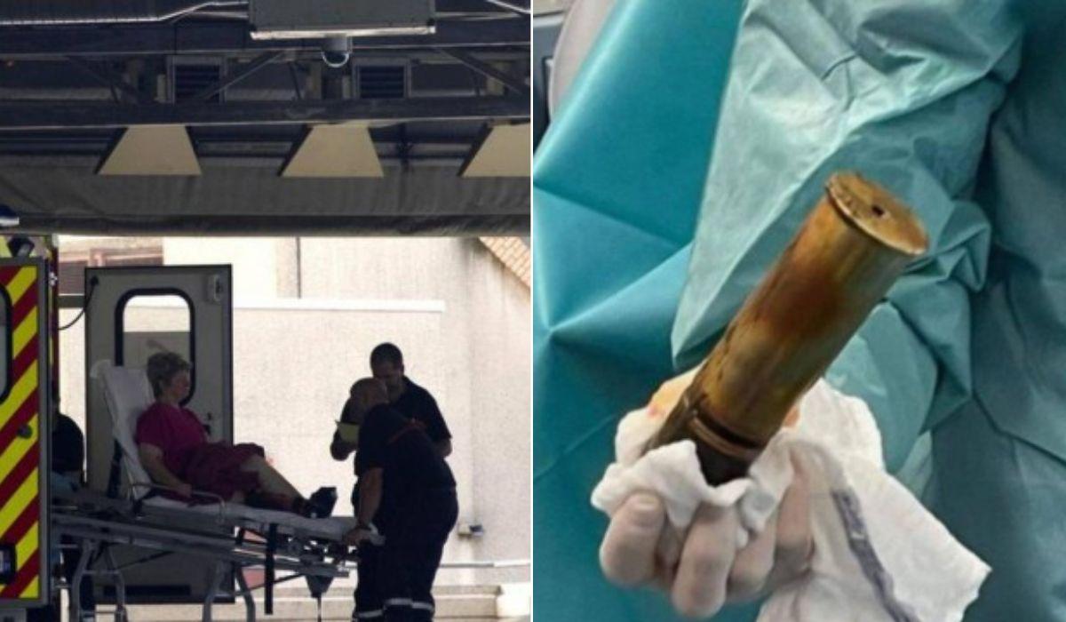 Bomba da Primeira Guerra Mundial retirada do nus de homem